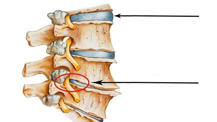 گریوا osteochondrosis کی صورت میں ریڑھ کی ہڈی کی چوٹ۔