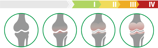 گھٹنے کے جوڑوں کے آرتروسیس کے کلینیکل مراحل (گھٹنے کے جوڑوں کے آرتروسیس کی ڈگری)