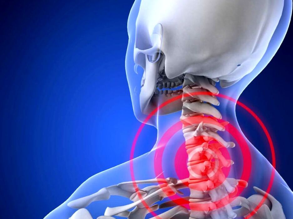 osteochondrosis کے ساتھ گردن میں درد