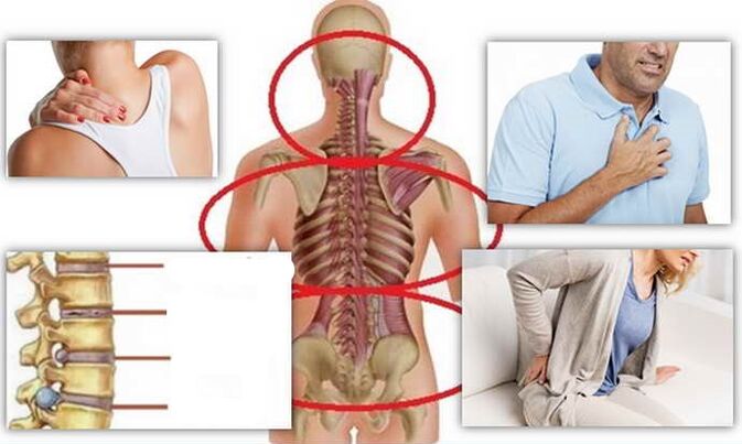 آسٹیوچنڈروسس کے لئے بیماری کے مقامات