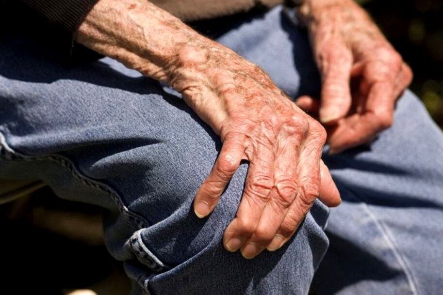 آرتھروسس ایک عمر سے متعلق بیماری ہے جو بوڑھے لوگوں میں ہوتی ہے۔